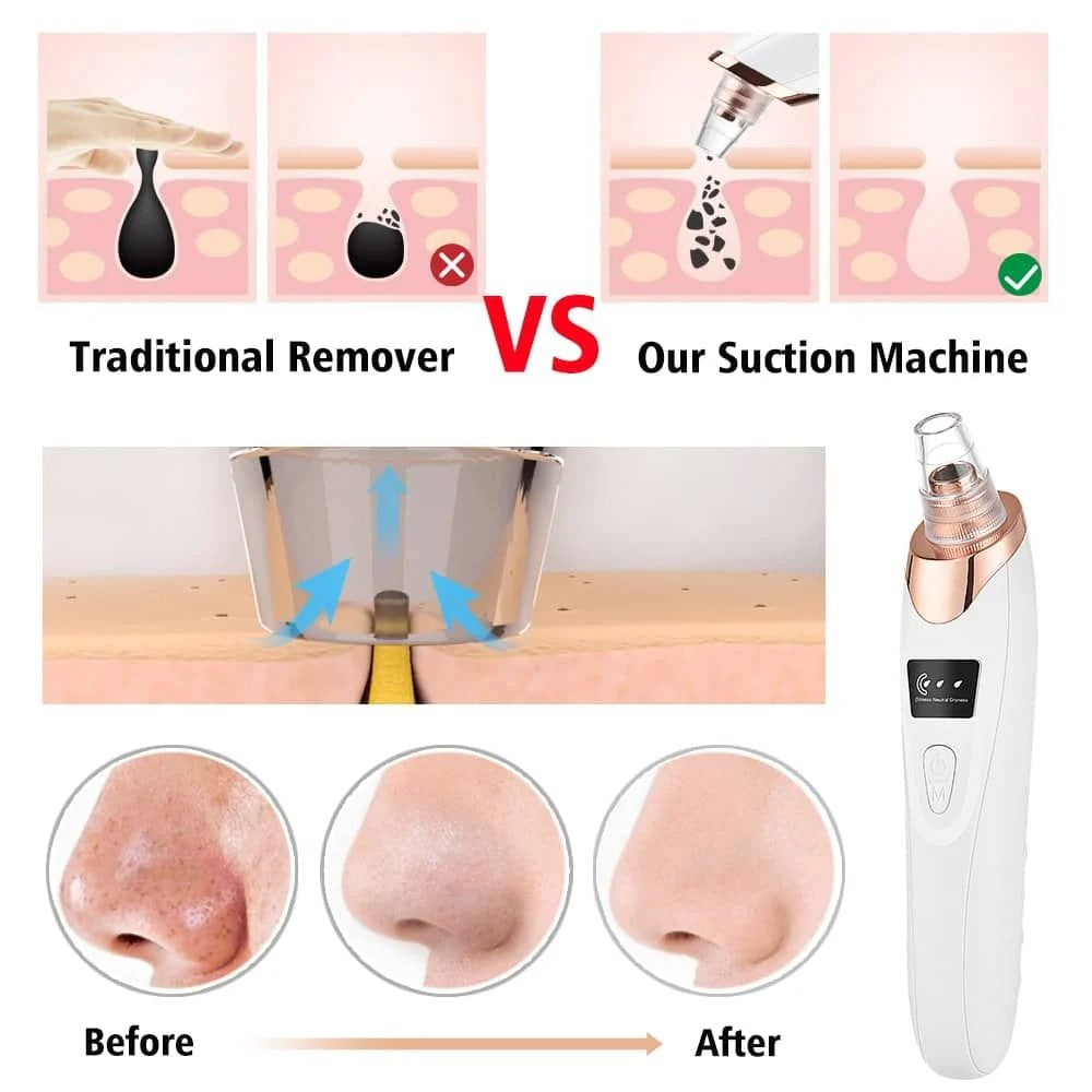 5 in 1 Blackheads Remover Pore Cleaner | Rechargeable
